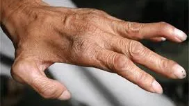 Două cazuri de lepră confirmate la Cluj după 44 de ani - Riscuri și precauții pentru seniori