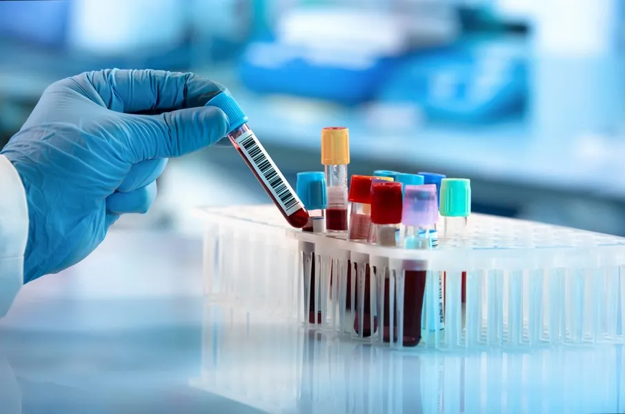 Avansuri în detectarea precoce a cancerului cerebral prin analize de sânge
