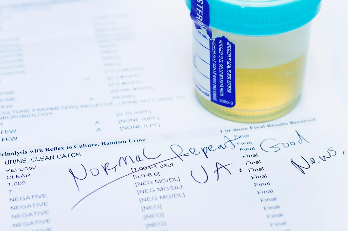 Test de urină de acasă depistează 9 din 10 cazuri de cancer de vezică urinară