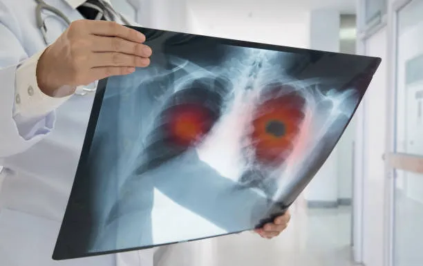 Tuse persistentă peste trei săptămâni: medicii avertizează asupra riscului de cancer pulmonar